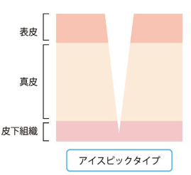 キュアジェット・クレーター治療【神戸・芦屋・西宮】Olino