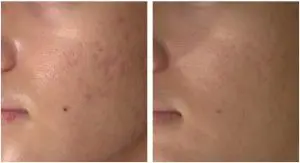 キュアジェット・クレーター治療【神戸・芦屋・西宮】Olino